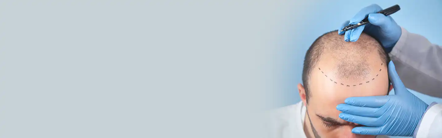 FUE Hair Transplant