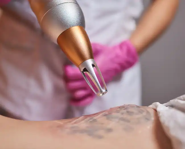 Laser Tattoo Removal