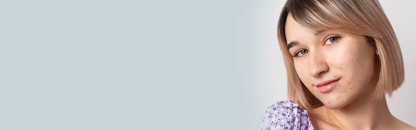 Acne Scar Treatment in South Delhi