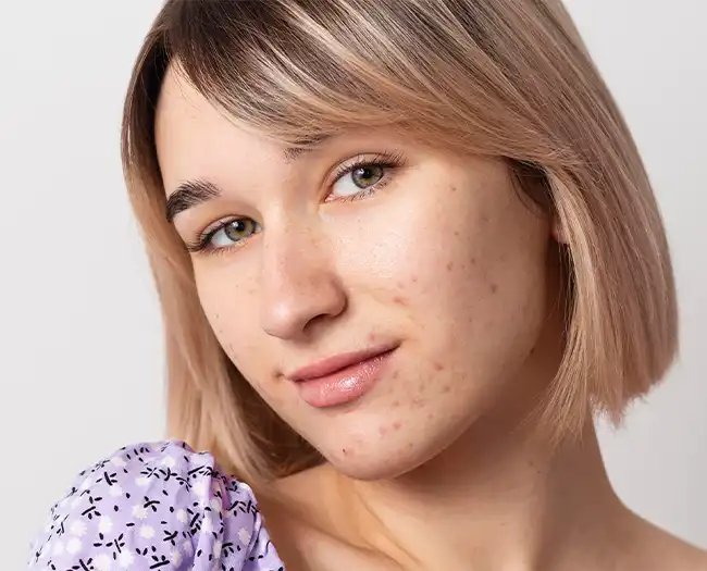 Acne Scar Treatment in South Delhi