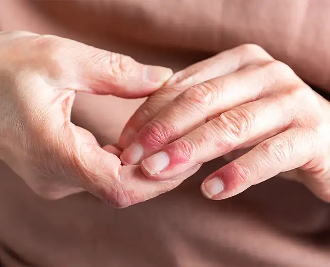 Eczema treatment