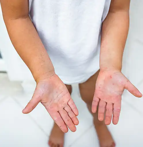 How to Manage Psoriasis?