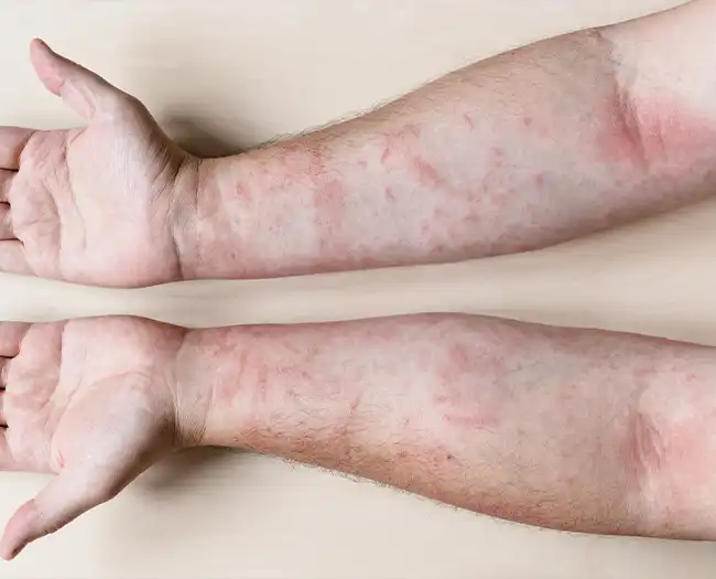 Psoriasis Treatment