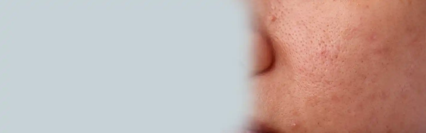Open Pores Treatment in Greater Kailash
