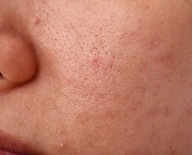 Open Pores Treatment in Greater Kailash