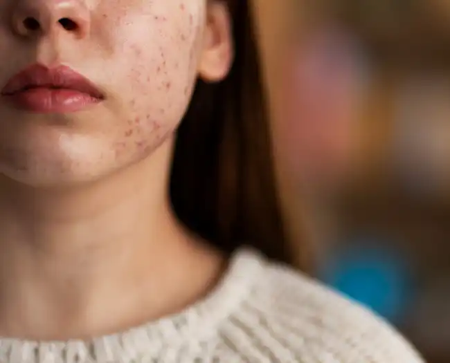 Acne Treatment in Delhi
