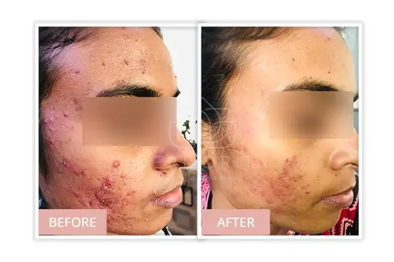 General Dermatology Before and after Real Results