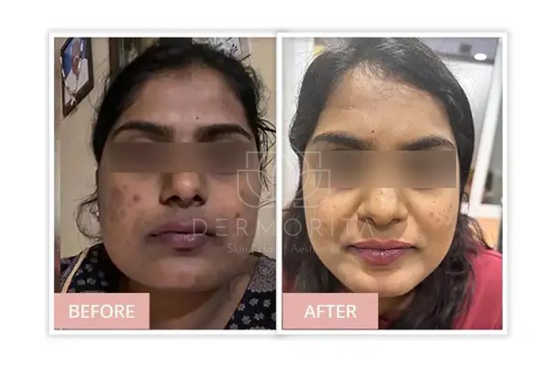 Acne and Acne Scars Before and after Real Results